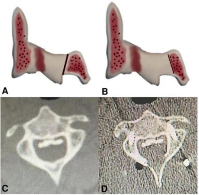 Comparison of C2 dome-like laminectomy with C2 partial laminectomy for upper cervical ossification of the posterior longitudinal ligament